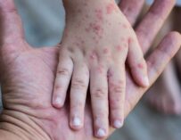 Declaran alerta epidemiológica por sarampión en Santiago Atitlán