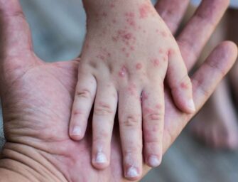 Declaran alerta epidemiológica por sarampión en Santiago Atitlán