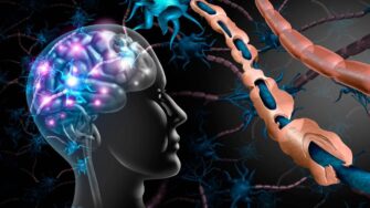 La importancia de ejercitarse al momento de ser diagnosticado con esclerosis múltiple